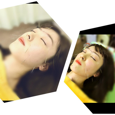 美容はり (45分）